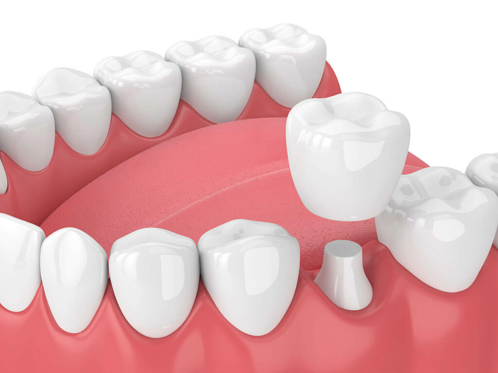dental crown and bridge service graphic