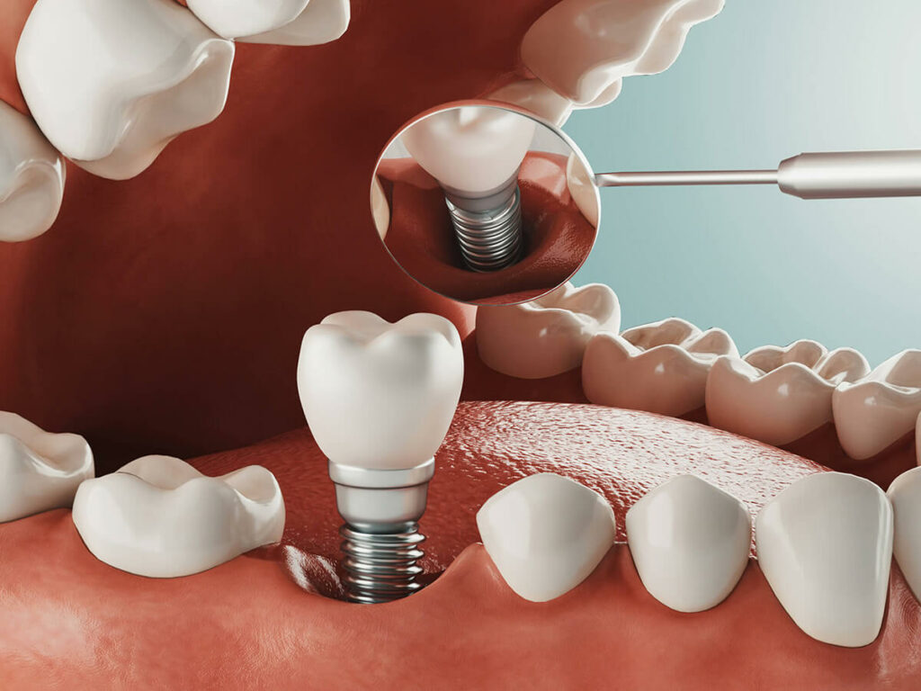 dental implant service graphic