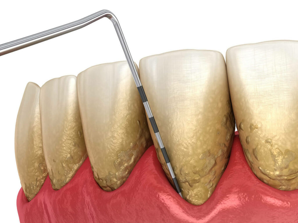 gum disease graphic