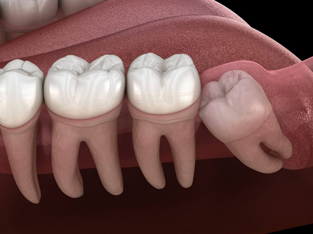 wisdom tooth removal graphic