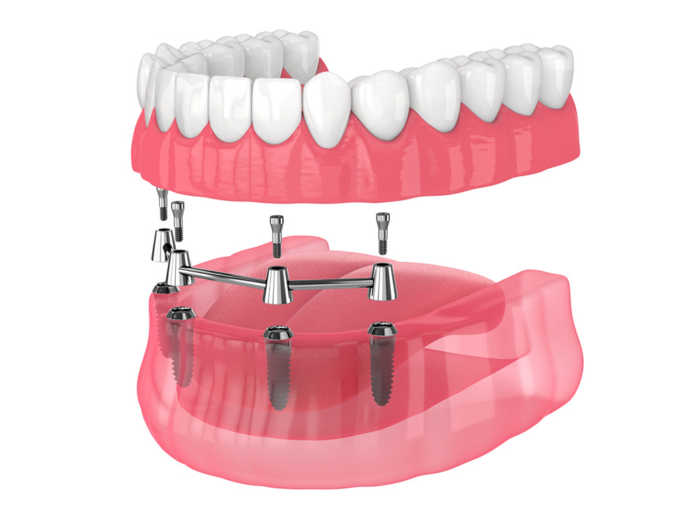 All on 4 dental implants graphic