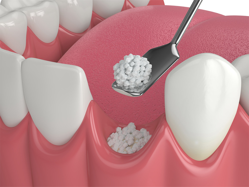 Dental Bone Grafting graphic