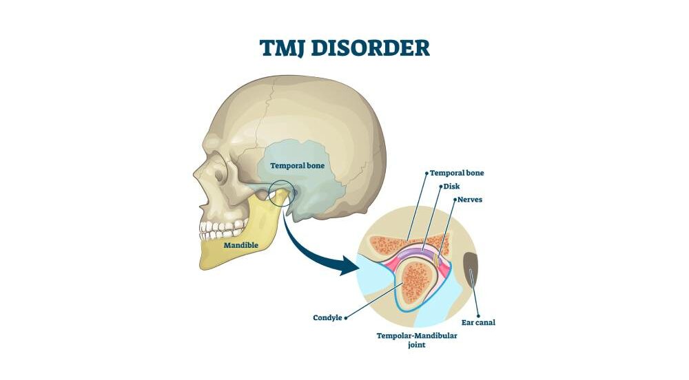 tmj disorder graphic