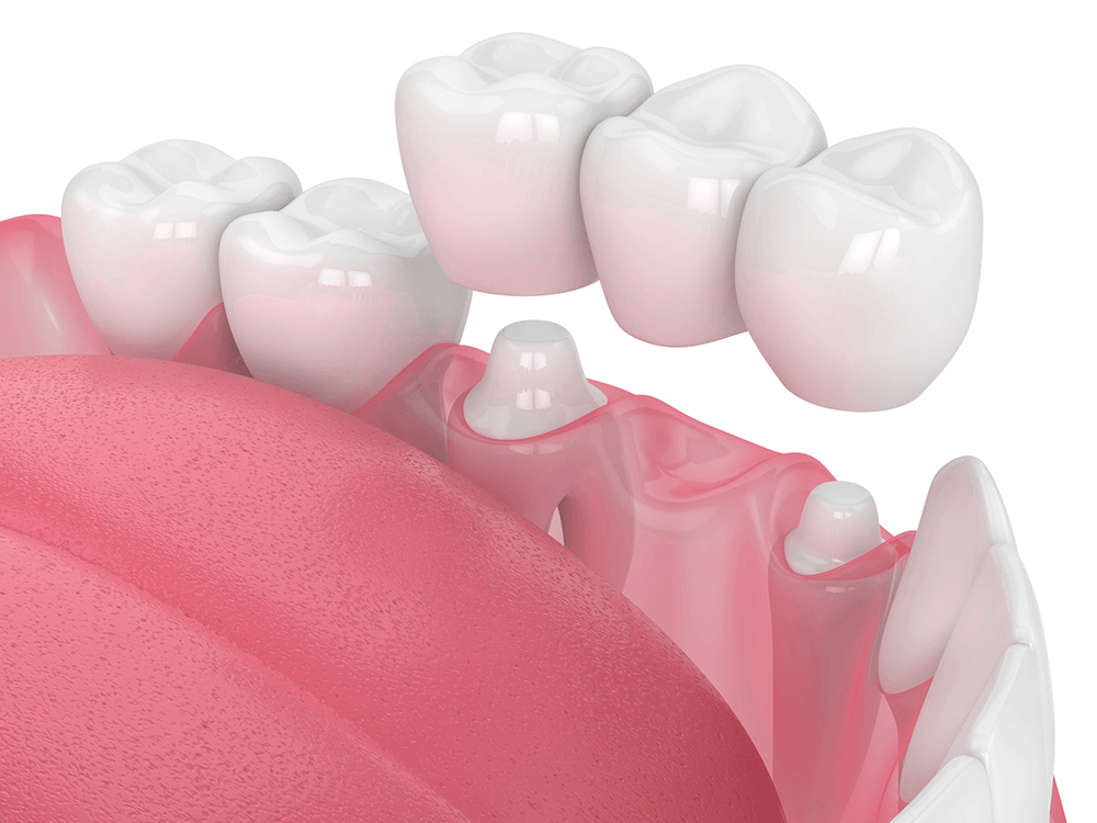 dental crowns and bridges