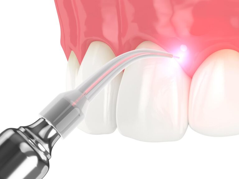 Soft Tissue Laser.