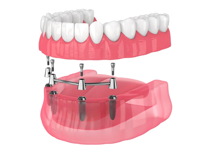 All-on-4 Dental Implants