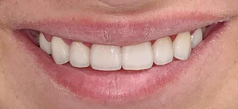Smile after getting veneers at Winter Dental in Arvada, CO.