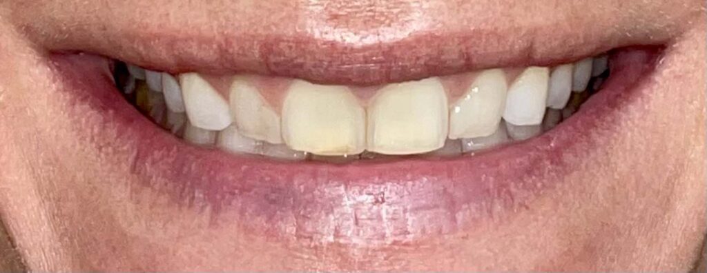 Smile before getting dental veneers at Winter Dental in Arvada, CO.