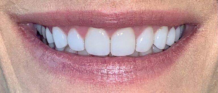 Smile after getting veneers at Winter Dental in Arvada, CO.