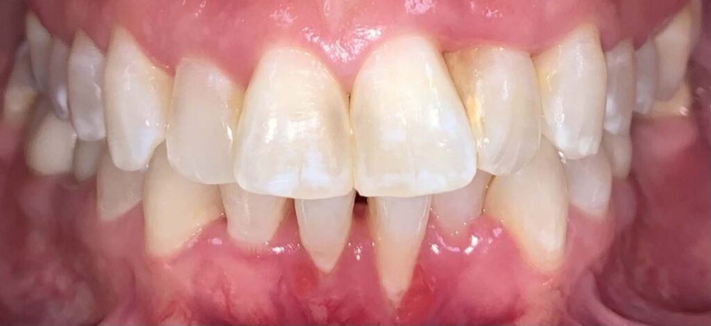 Smile before getting dental veneers at Winter Dental in Arvada, CO.