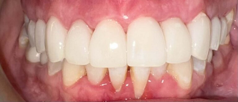 Smile after getting veneers at Winter Dental in Arvada, CO.