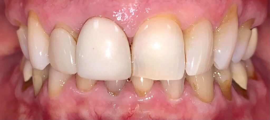Smile before getting dental veneers at Winter Dental in Arvada, CO.