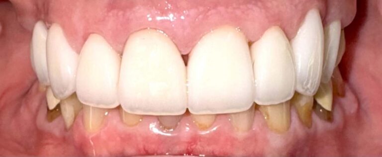 Smile after getting veneers at Winter Dental in Arvada, CO.
