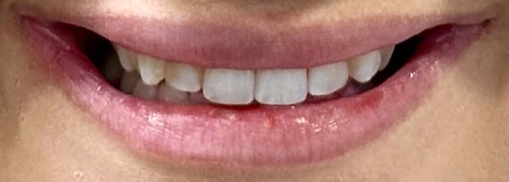 Smile before getting dental veneers at Winter Dental in Arvada, CO.