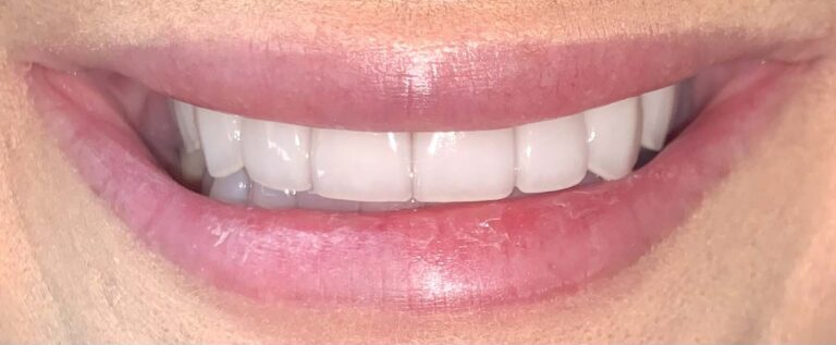 Smile after getting veneers at Winter Dental in Arvada, CO.