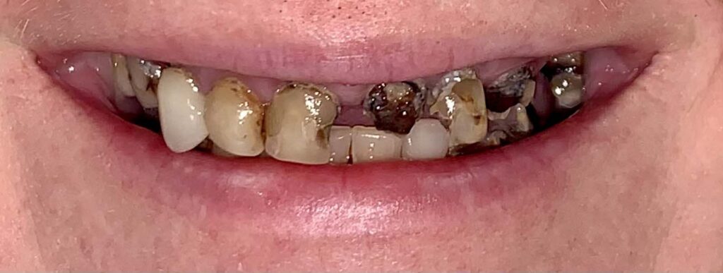 Smile before getting dental implants at Winter Dental in Arvada, CO.
