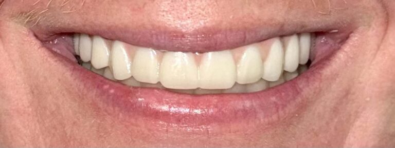 Smile after getting dental implants at Winter Dental in Arvada, CO.