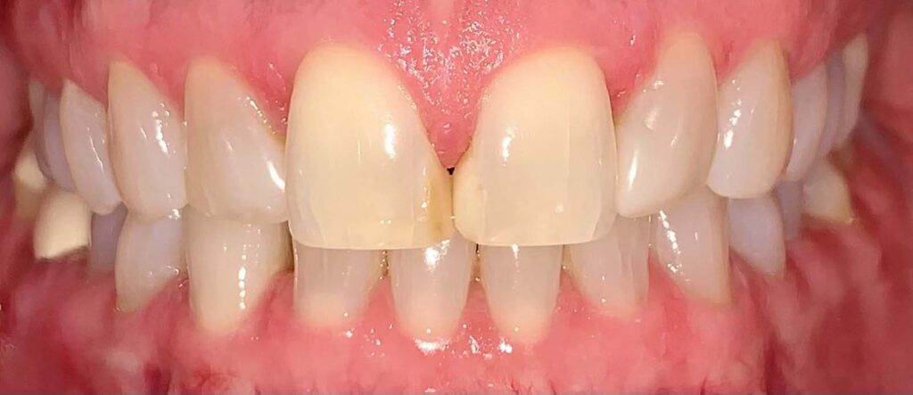 Smile before getting dental veneers at Winter Dental in Arvada, CO.