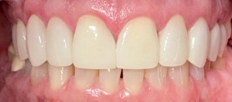 Smile after getting veneers at Winter Dental in Arvada, CO.