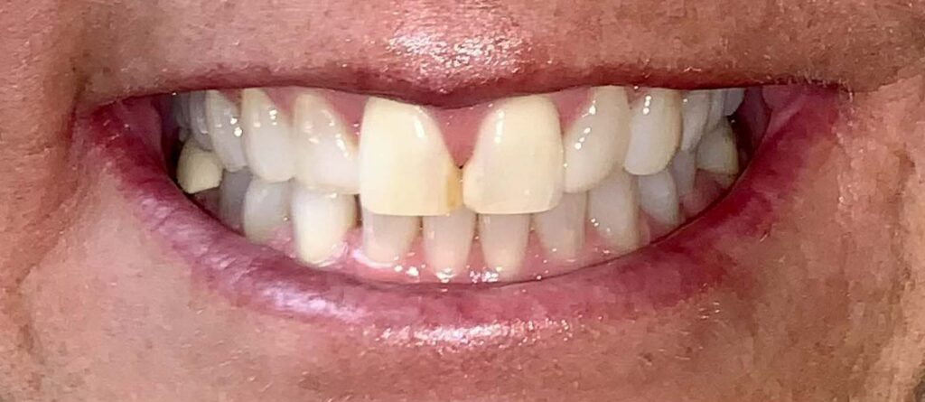 Smile before getting dental veneers at Winter Dental in Arvada, CO.