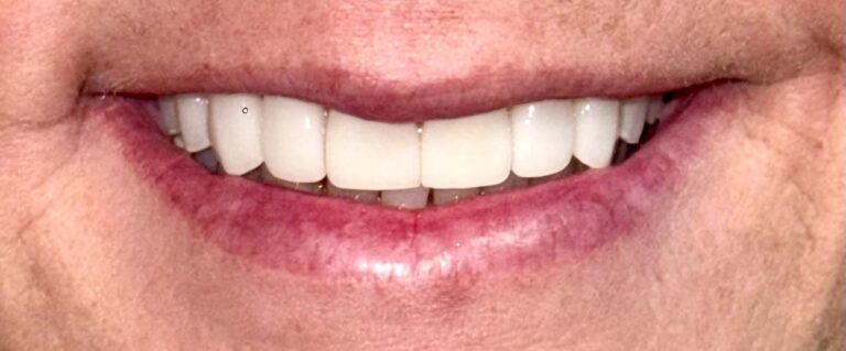 Smile after getting veneers at Winter Dental in Arvada, CO.