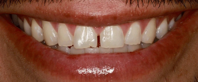 Smile before getting dental veneers at Winter Dental in Arvada, CO.
