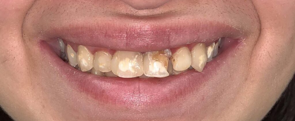 Smile before getting dental veneers at Winter Dental in Arvada, CO.