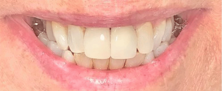 Smile after getting dental implants at Winter Dental in Arvada, CO.