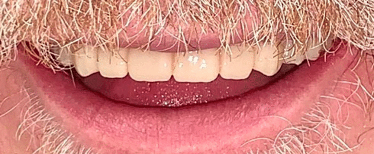 Smile after getting dental implants at Winter Dental in Arvada, CO.