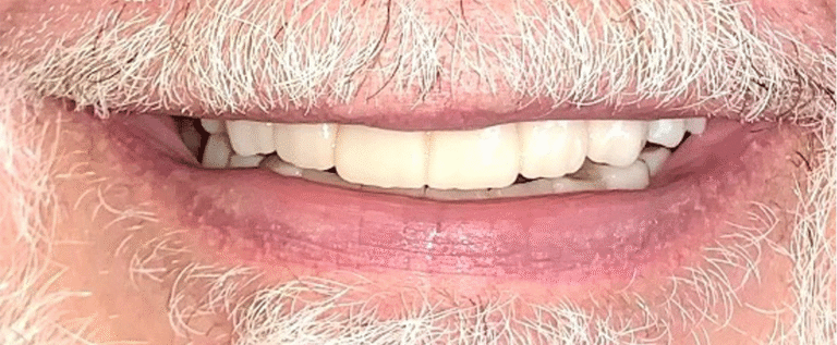 Smile after getting dental implants at Winter Dental in Arvada, CO.