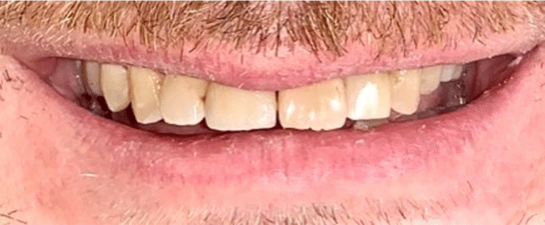 Smile after getting dental implants at Winter Dental in Arvada, CO.