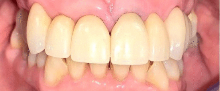 Smile after getting veneers at Winter Dental in Arvada, CO.
