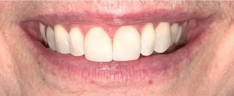 Smile after getting veneers at Winter Dental in Arvada, CO.