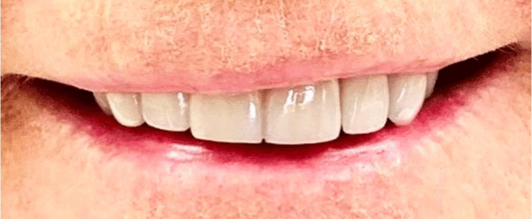 Smile after getting veneers at Winter Dental in Arvada, CO.