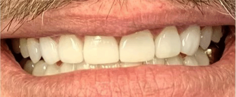 Smile after getting veneers at Winter Dental in Arvada, CO.