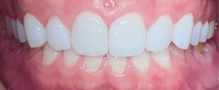 Smile after getting veneers at Winter Dental in Arvada, CO.