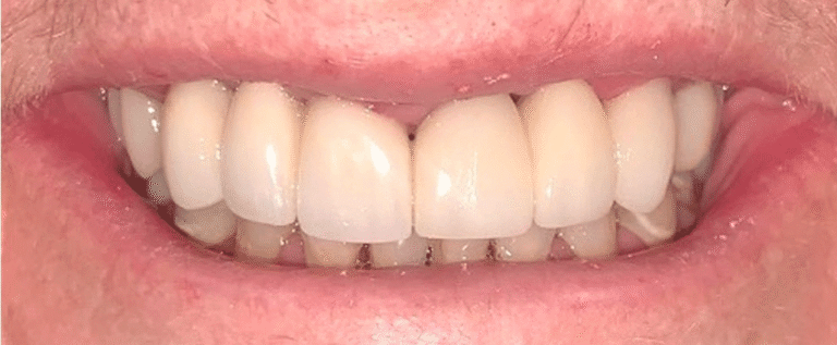 Smile after getting veneers at Winter Dental in Arvada, CO.
