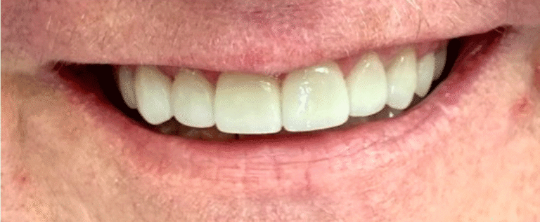 Smile after getting veneers at Winter Dental in Arvada, CO.