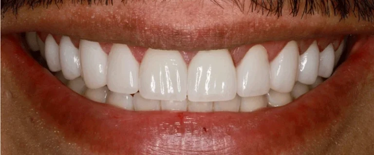 Smile after getting veneers at Winter Dental in Arvada, CO.