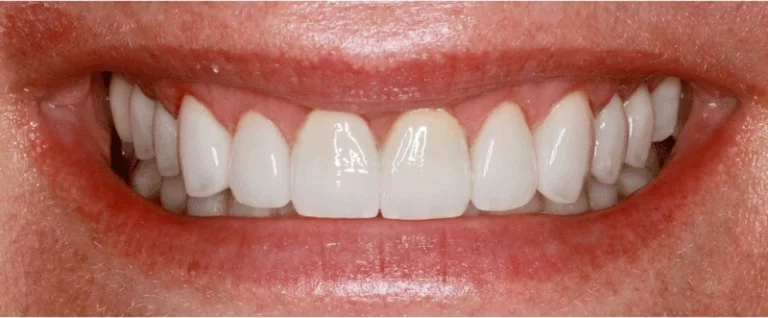 Smile after getting veneers at Winter Dental in Arvada, CO.