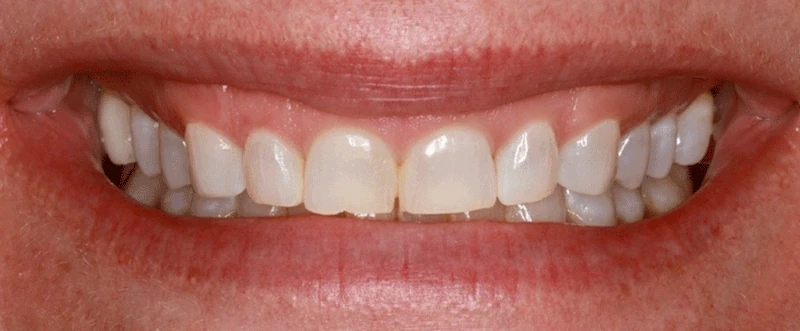 Smile before getting dental veneers at Winter Dental in Arvada, CO.
