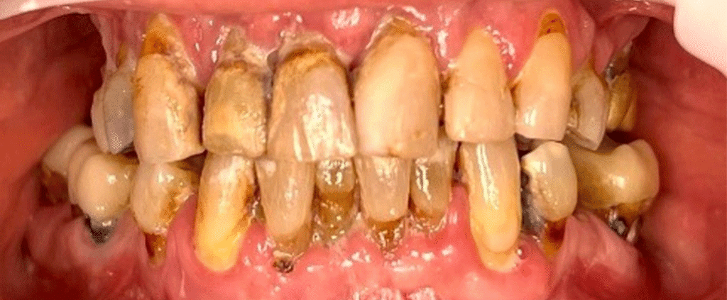 Smile before getting dental implants at Winter Dental in Arvada, CO.