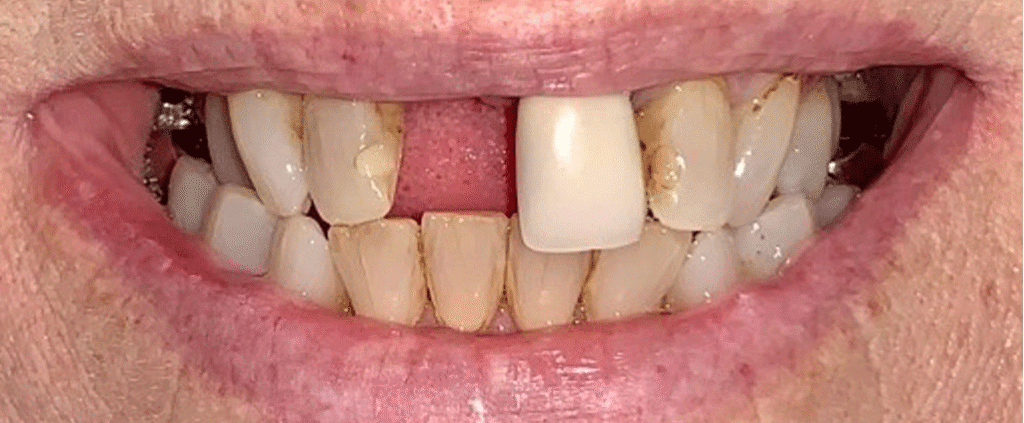 Smile before getting dental implants at Winter Dental in Arvada, CO.
