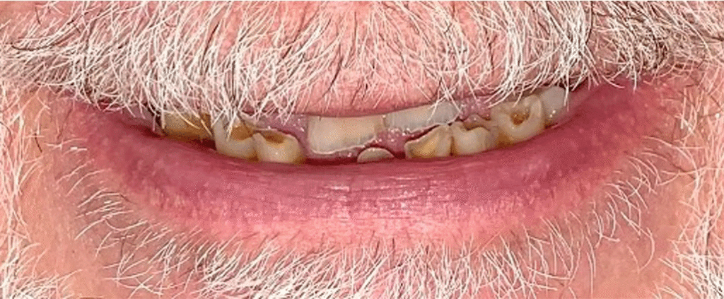 Smile before getting dental implants at Winter Dental in Arvada, CO.