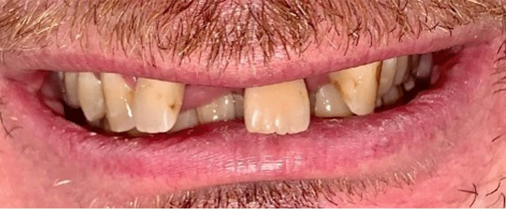 Smile before getting dental implants at Winter Dental in Arvada, CO.