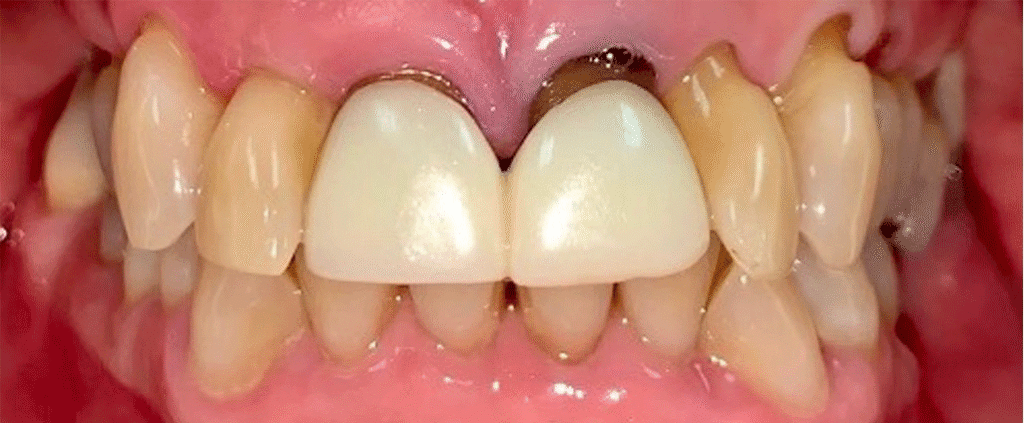 Smile before getting dental veneers at Winter Dental in Arvada, CO.