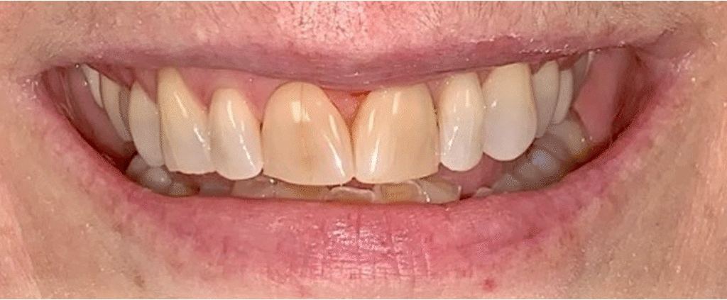 Smile before getting dental veneers at Winter Dental in Arvada, CO.