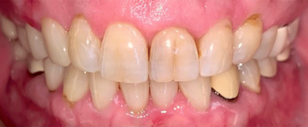 Smile before getting dental veneers at Winter Dental in Arvada, CO.