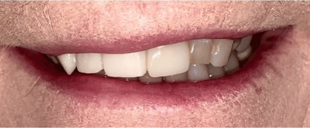 Smile before getting dental veneers at Winter Dental in Arvada, CO.