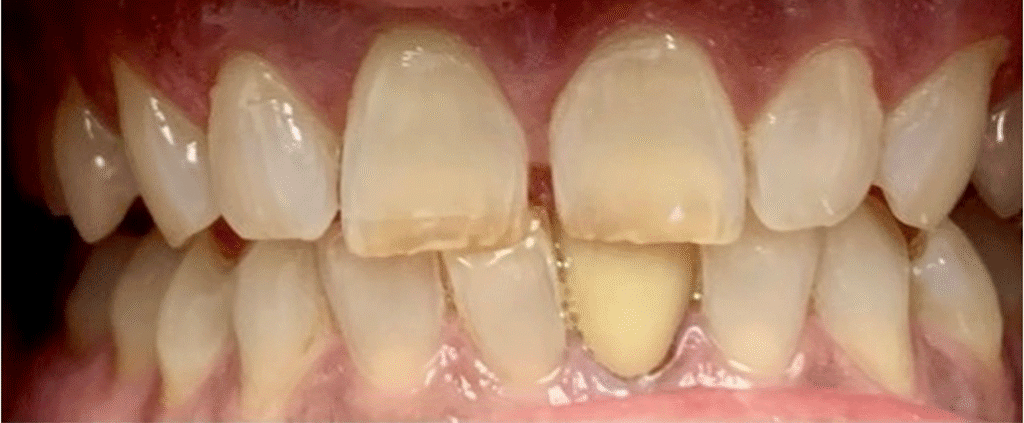 Smile before getting dental veneers at Winter Dental in Arvada, CO.